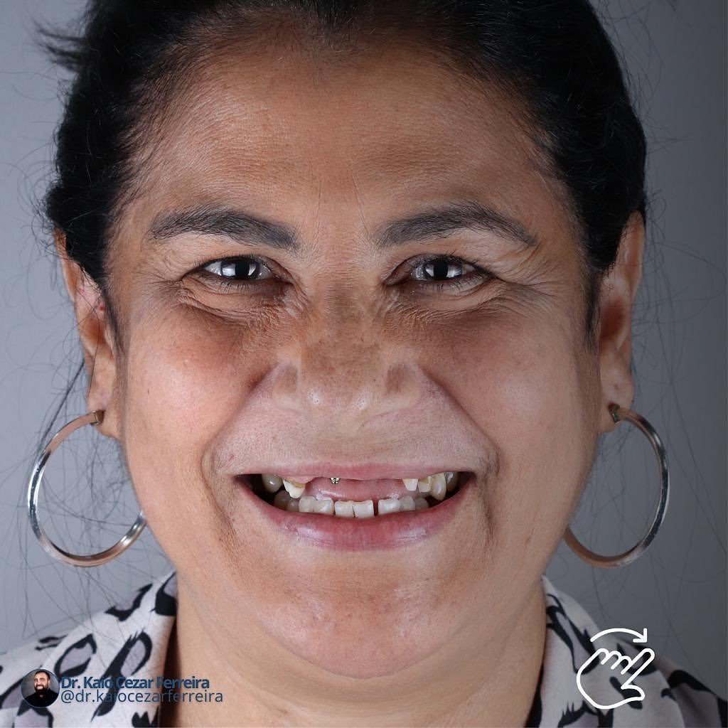 Sorriso antes do tratamento com Dr. Kaio Cézar