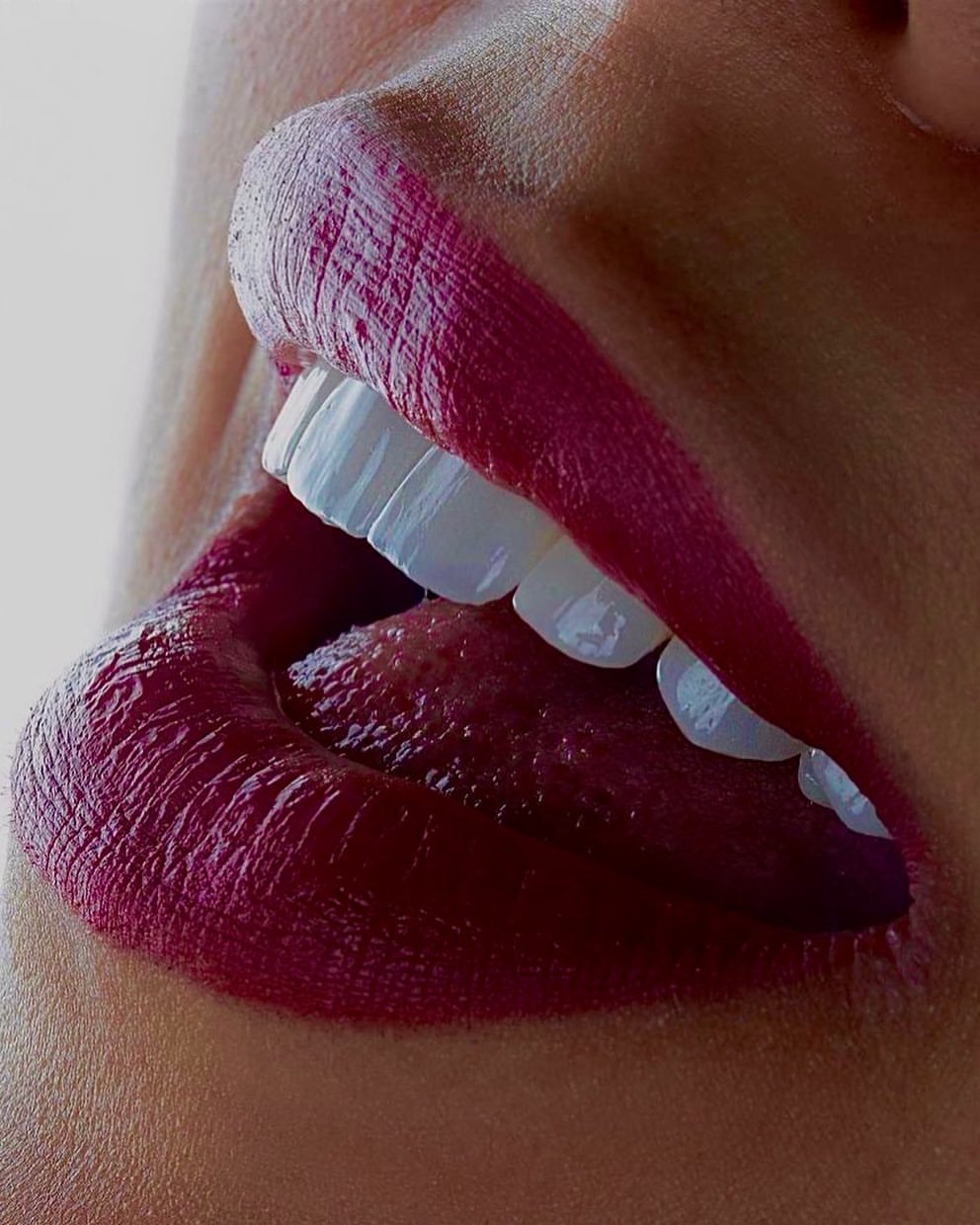 Facetas de porcelana — resultado do Dr. Kaio Cézar